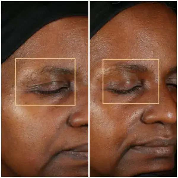 6 months post 1 treatment