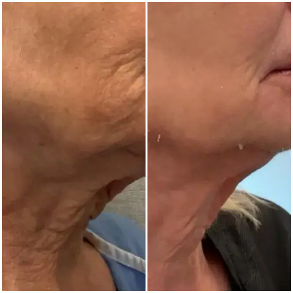 tightening-before-after-7