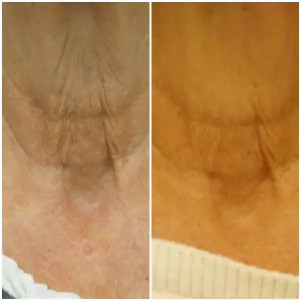 tightening-before-after-8