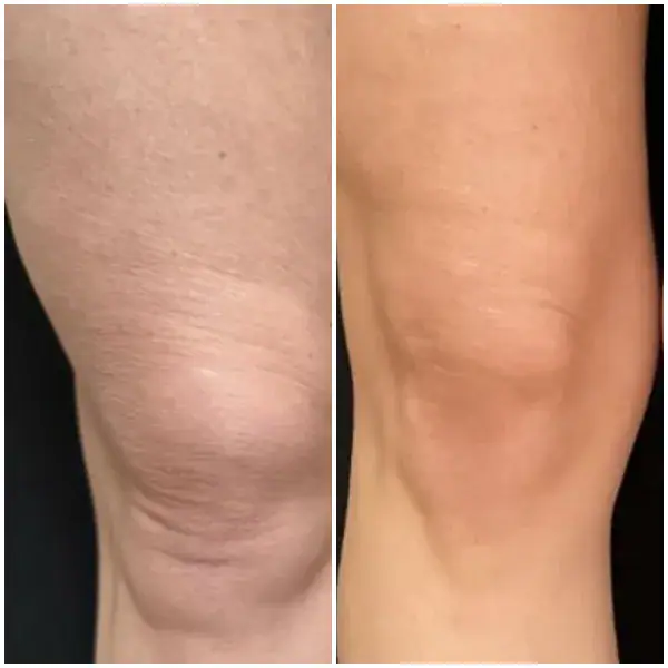 tightening-before-after-9