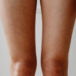 How to Get Rid of Strawberry Skin