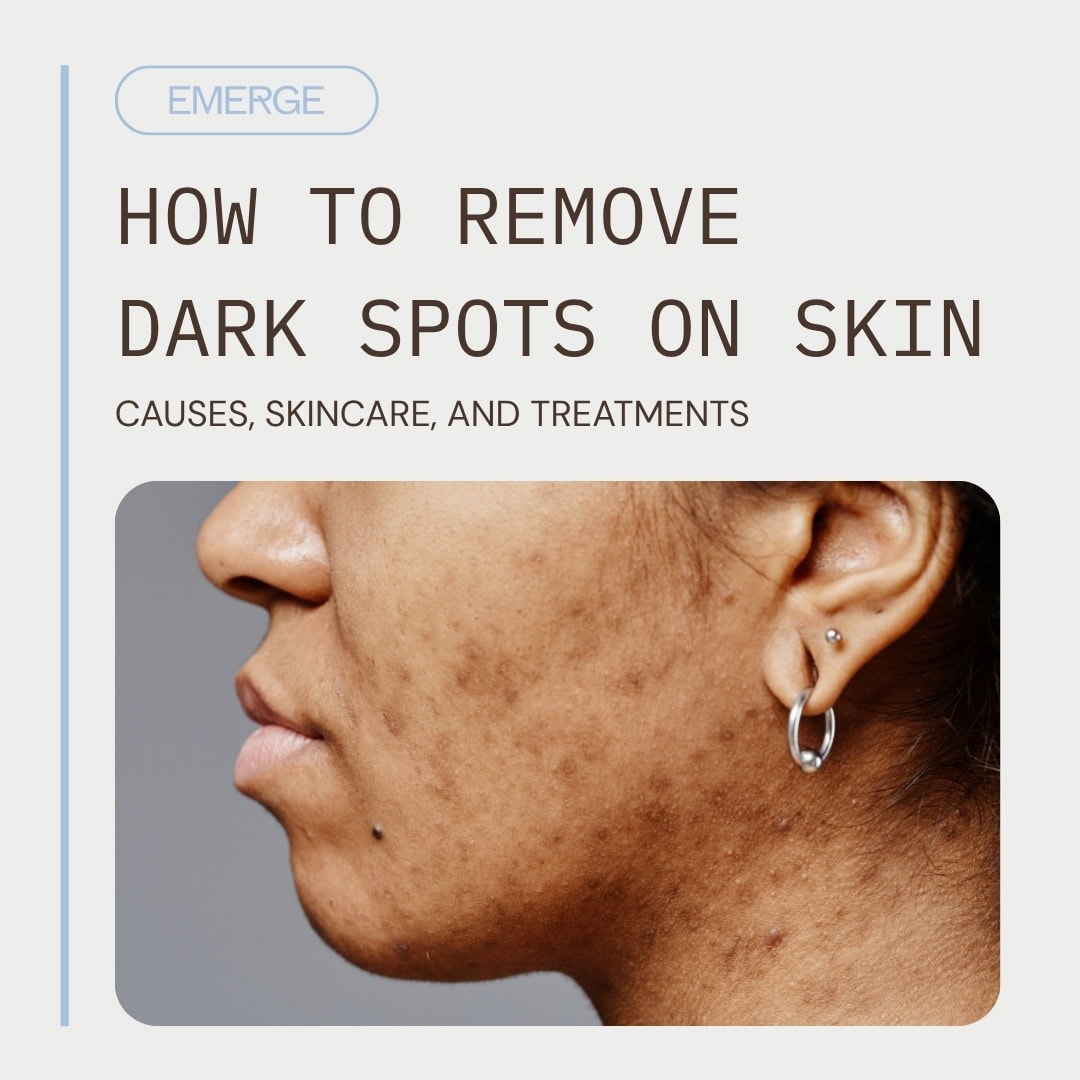 How to Remove Dark Spots on Skin Causes Skincare and Treatments