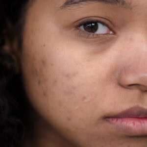How to Remove Dark Spots on Skin Causes Skincare and Treatments